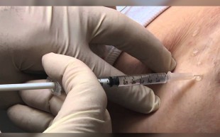 بوتاکس زیربغل در مطب شرقی