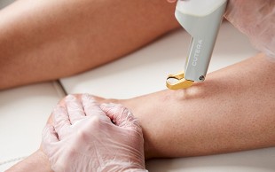 لیزر الکس سایناشور در کلینیک تندیس