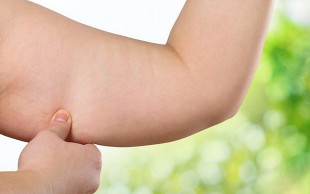 کرایولیپولیز 2016 وکیوم دار در مرکز لاغری عارف