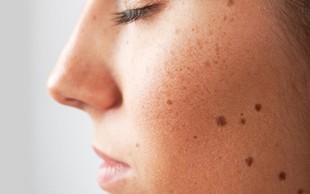 رفع لک و آکنه تراپی در کلینیک آفتاب تابان