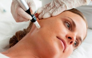 میکرونیدلینگ در مطب دکتر حسینی