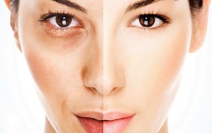 هایفو جوانسازی بانوان در مرکز پوست سیدخندان