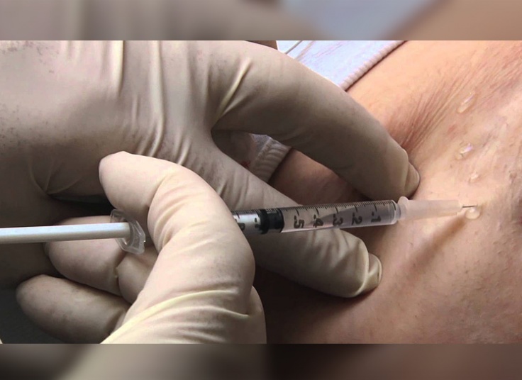 بوتاکس زیربغل در مطب شرقی