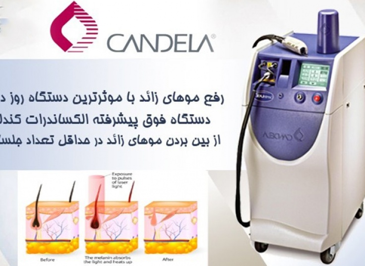 لیزر الکس کندلا 2017 در کلینیک دکتر کیانی