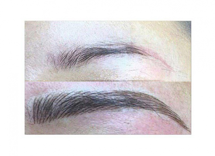 میکروپیگمنتیشن سالن نیلای