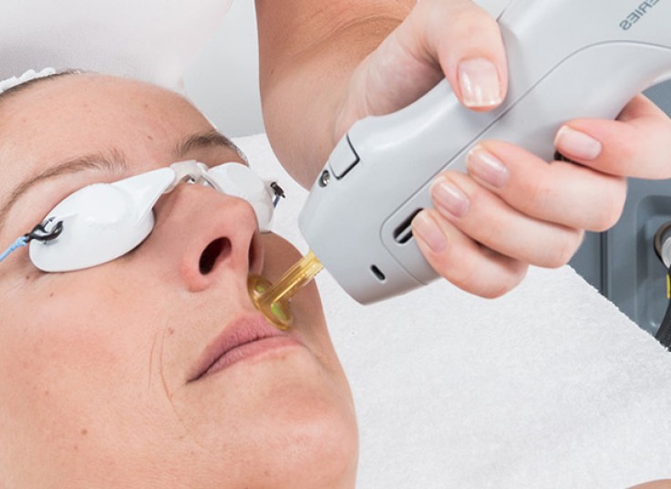 لیزر SHR در کلینیک کهربا