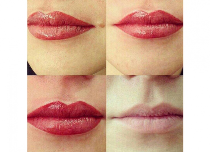 میکروپیگمنتیشن سالن نیلای