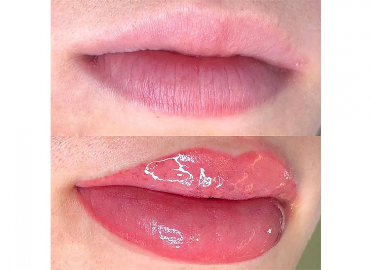 میکروپیگمنتیشن سالن لیانا