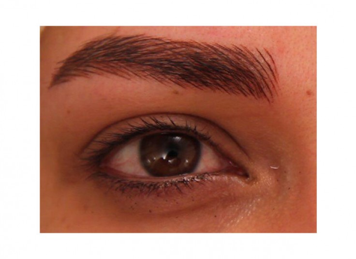 میکروپیگمنتیشن سالن نیلای