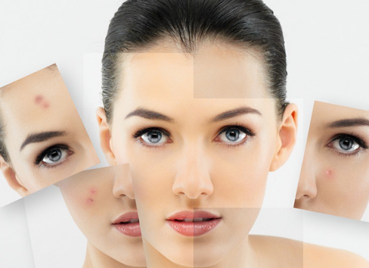 پیگمانته تراپی و درمان  جای جوش در مطب صبا