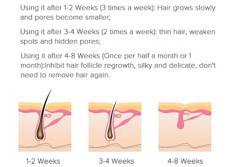 دستگاه لیزر موهای زائد Xiaomi