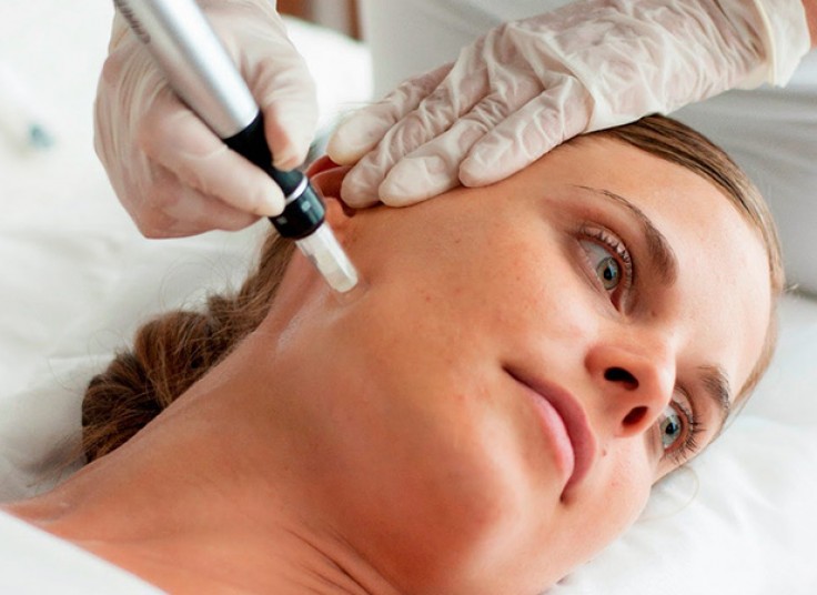 میکرونیدلینگ در مطب دکتر حسینی