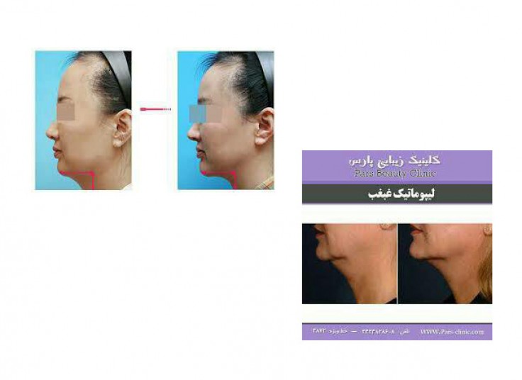 رفع غبغب کلینیک WomenHealth