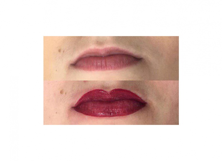 میکروپیگمنتیشن سالن نیلای