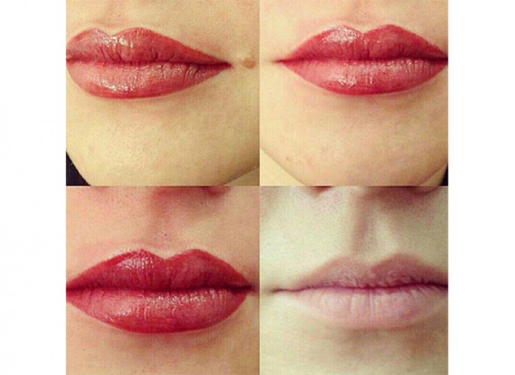 میکروپیگمنتیشن سالن نیلای